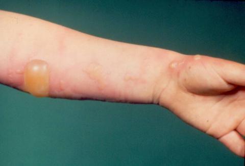 giant hogweed burn